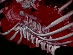 CU CT scan of human abdominal cavity / Vermont, USA Stock Footage