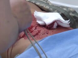 Abdominal Wound Stock Footage