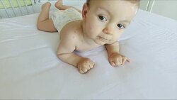 Crying baby girl with measles Stock Footage