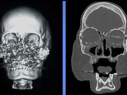 The woman who underwent the nation's first face transplant at the Cleveland Clinic is now speaking out to encourage people to become organ donors. News Clip