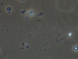 Human sperm, single sperm swimming strongly Stock Footage