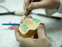 Dental prosthesis Stock Footage