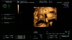 Pregnant 4D ultrasound Stock Footage