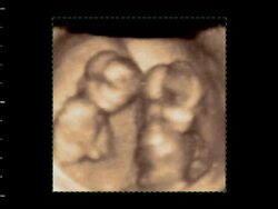 Twin foetuses moving in the womb, 4D ultrasound scan.. Stock Footage