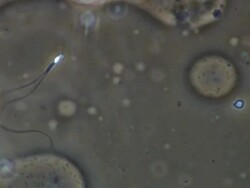 Human sperm swimming, close up, including two tailed Human sperm, Phase contrast Stock Footage