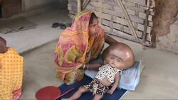 CLEAN : Indian doctors complete surgery on baby News Clip