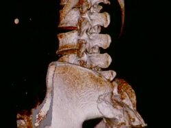 CU CT scan of spinal cord and ileum / Vermont, USA Stock Footage