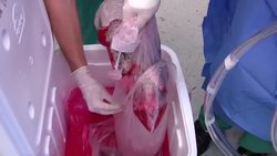 Researchers say a little-known fact about lungs - they can stay alive for hours after someone dies - could increase the number of lungs suitable for transplant. A new study involves sudden deaths, precision timing and a sci-fi like test chamber. (Nov. 18) News Clip