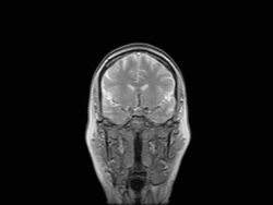 MRI Scan Of Human Brain Stock Footage