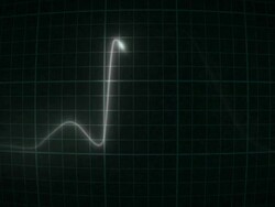 EcG_HeartAttackInTimeConvexScreen Stock Footage