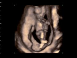 Foetus kicking and moving in womb, 4D ultrasound.. Stock Footage