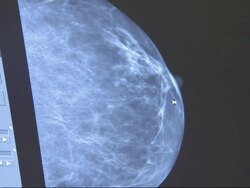 Older Women less likely to have Breast Cancer Ops News Clip