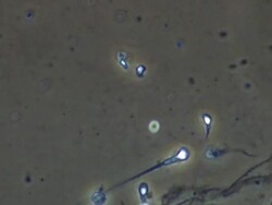 Human sperm, single sperm swimming strongly Stock Footage