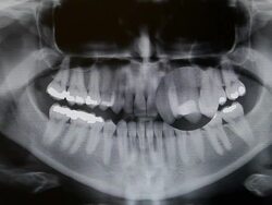 Digital Dental Pan X-ray Magnification Stock Footage
