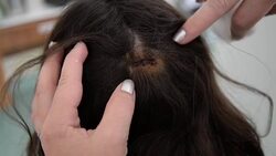 Cleaning wounds Stock Footage