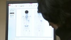 New scanning technique to improve  bone marrow cancer treatment ++EMBARGOED++ News Clip
