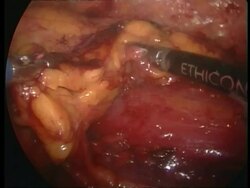 ECU cauterising blades cutting through tissue, via internal camera Stock Footage