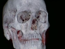 CU CT scan of human skull / Vermont, USA Stock Footage