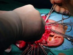 HD: Close-up tumor surgery Stock Footage