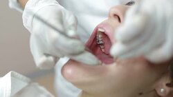Mending patient's teeth Stock Footage