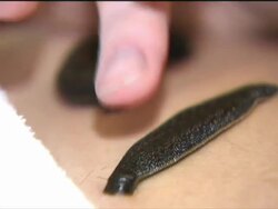 Leech farm and leech treatment News Clip