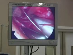 Facelift operation, clip 10 of 24. Stock Footage