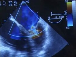 Keyhole mitral valve surgery 4 of 26. Stock Footage