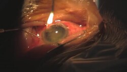 step 4. Surgery Cataract Eye. Category-B Stock Footage