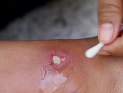 Cleaning wound with normal saline solution. Stock Footage