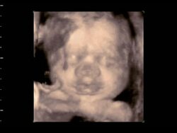 Close up on Foetus face, 4D ultrasound.. Stock Footage