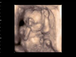 Foetus in the womb, 4D ultrasound scan.. Stock Footage