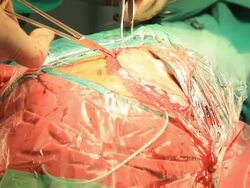 surgery Stock Footage