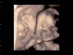 Foetus opening mouth very wide, 4D ultrasound scan.. Stock Footage
