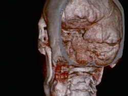 CU CT scan of human skull / Vermont, USA Stock Footage
