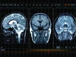 Brain MRT scan display Stock Footage