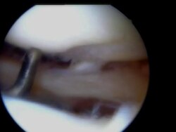 Knee Arthroscopy with Teaser Instrument Stock Footage