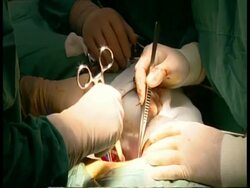 MCU Surgeon's hands operating inside body cavity with surgical instruments Stock Footage