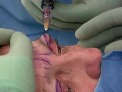 Facelift operation, clip 17 of 24. Stock Footage