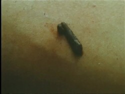 Leech removed whilst sucking blood from human skin, Indian rainforest Stock Footage