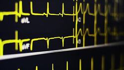 ECG Stock Footage