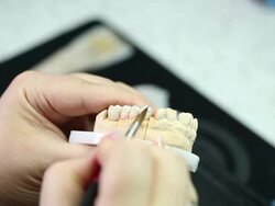 Dental prostetics Stock Footage