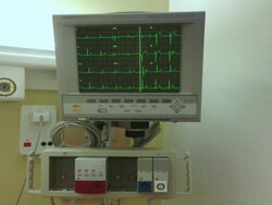 ECG of a stopping heart Stock Footage