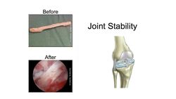 Kevin Stone: The bio-future of joint replacement Instructional Video