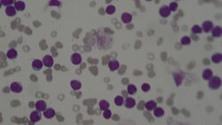 Myeloblast in Leukemia disease under microscope 400X Stock Footage