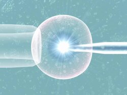IVF procedure. IVF (in vitro fertilisation) is the fertilisation of an egg cell (centre) outside the human body. Stock Footage