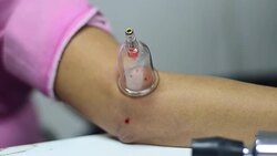 medical treatment Stock Footage