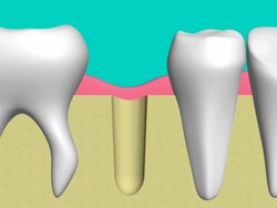 technology of dental implants Stock Footage