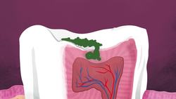 What causes cavities? - Mel Rosenberg Instructional Video