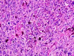 Microscopic image of human cancer cells, melanoma Stock Footage