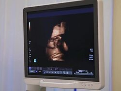 Medicine. Ultrasound images on a monitor. Stock Footage